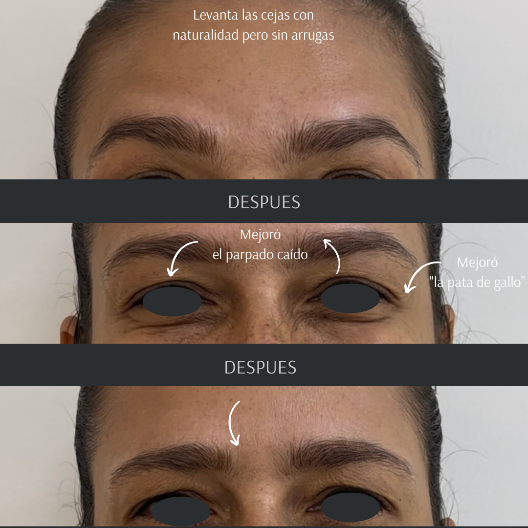 Toxina Botulínica mas conocido como Botox. Es una neurotoxina que utilizamos para DISMINUIR la contractilidad muscular y con ello atenuar y prevenir las arrugas dinámicas que se crean como consecuencia de nuestra gesticulación. La idea no es hacer desaparecer esa expresión que te hace ser TU, la idea es disimular y retrasar la aparición de esas arruguitas que tanto nos molestan. Aqui te espero, agendate!