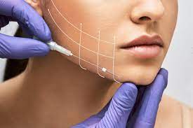 Hilos Tensores y Lifting No Quirúrgico - Rejuvenecimiento Facial Avanzado