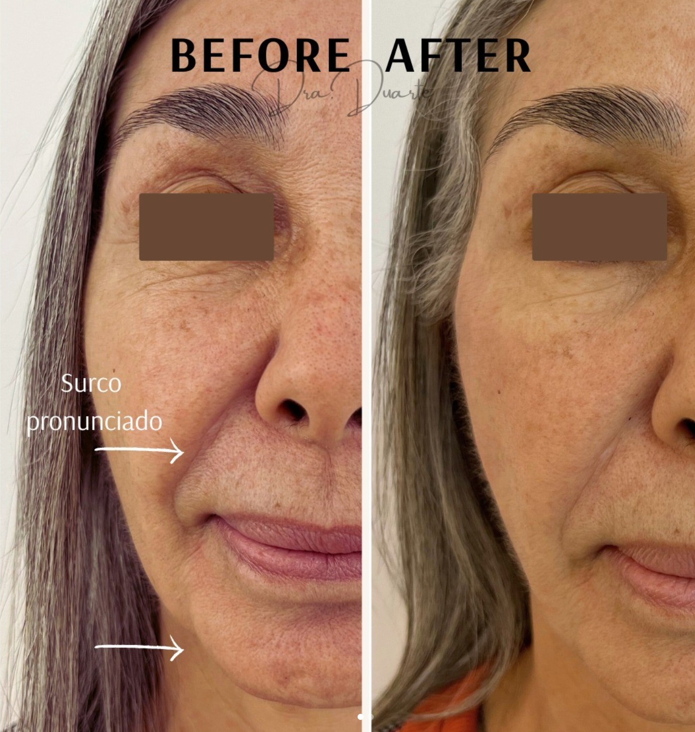 Resultados visibles de lifting facial con hilos tensores realizados por la Dra. Duarte en Armenia, mostrando una reducción notable de surcos nasolabiales y mejora en la firmeza de la piel para un rejuvenecimiento facial notorio.