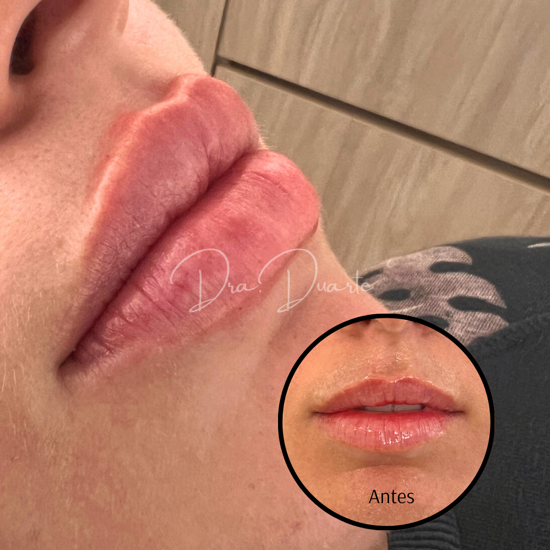 Antes y después del perfilamiento de labios en una paciente femenina. La imagen muestra una mejora significativa en la forma y volumen de los labios, logrando una apariencia más definida y natural